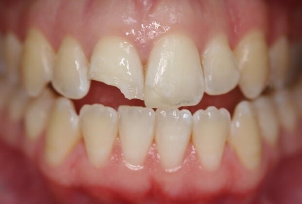 Nên trám răng hay bọc răng sứ cho răng bị sứt mẻ?