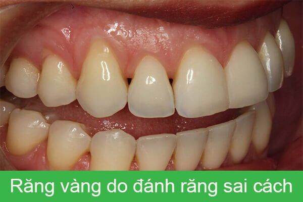 răng bị vàng do đánh răng sai cách