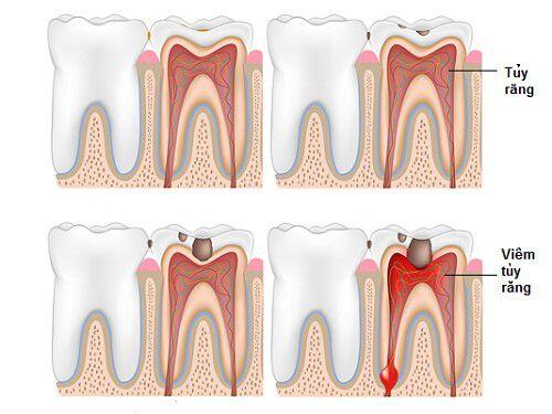 răng bị viêm tủy chảy dịch màu trắng có nguy hiểm