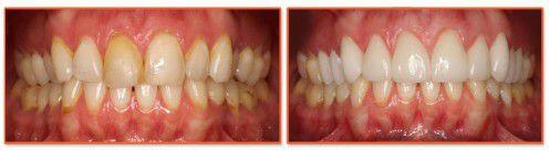 Bọc răng sứ cho trường hợp răng nhiễm màu nặng