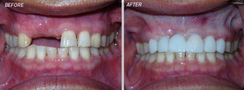 Bọc răng sứ cần đảm bảo được những tiêu chí gì ?