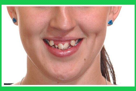 Những ảnh hưởng của răng chuột tới khuôn miệng