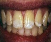 Răng có nhiều đốm trắng đục trên bề mặt phải làm sao ?