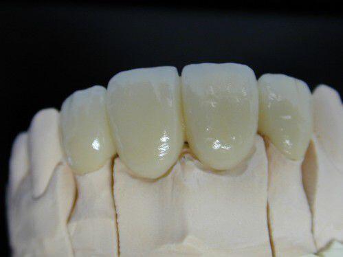 Răng đã lấy tủy thì tồn tại được bao lâu ?