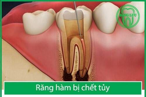 Răng hàm đã chết tủy có nên nhổ không ? 1