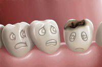 Diễn biến nghiêm trọng của bệnh sâu răng