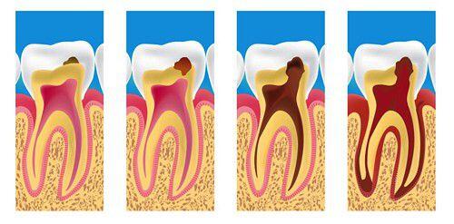 răng hàm sâu không điều trị có nguy hiểm