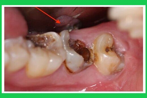 Răng hỏng gây hại cho cơ thể như thế nào