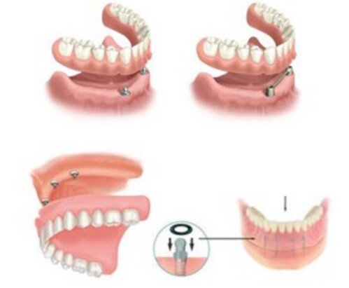 Răng implant tháo lắp