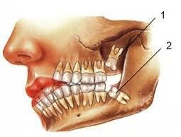 răng khôn là gì