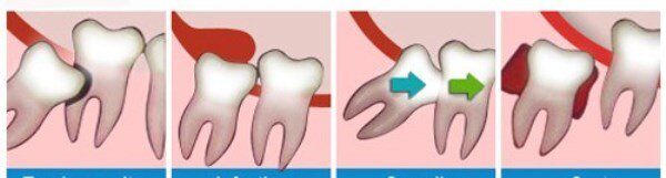 Răng khôn là gì ?