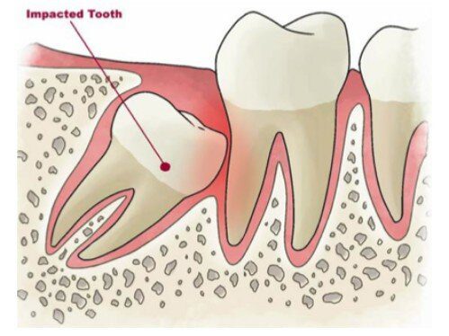 Răng khôn là răng thứ mấy?