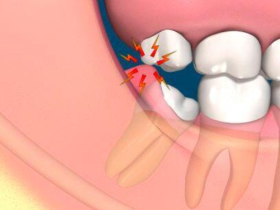 Răng khôn mọc ngầm có nên nhổ không?