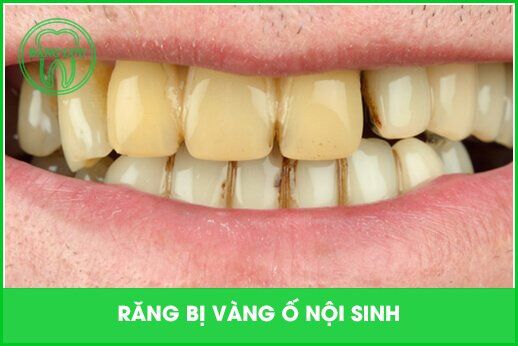 răng bị vàng do yếu tố nội sinh