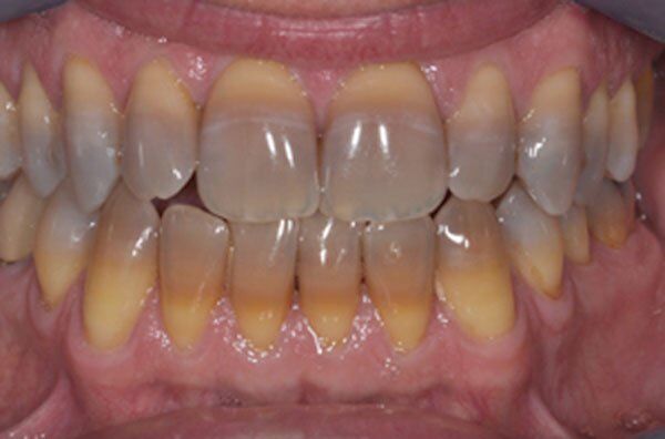 Răng bị nhiễm Tetracycline có tẩy trắng được không?