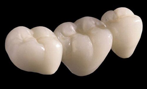 Răng sứ Cercon có mấy loại?