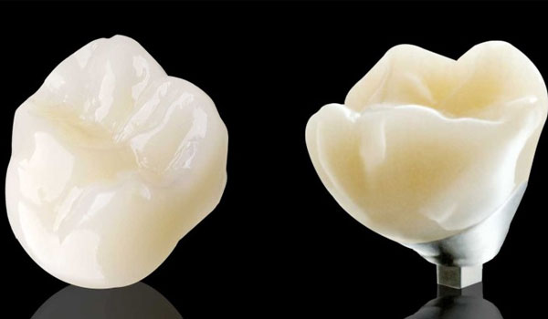 Răng sứ không kim loại Cercon là gì?