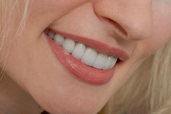 Răng sứ không kim loại Cercon là gì ?
