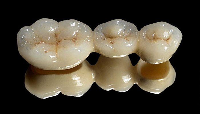 răng sứ kim loại