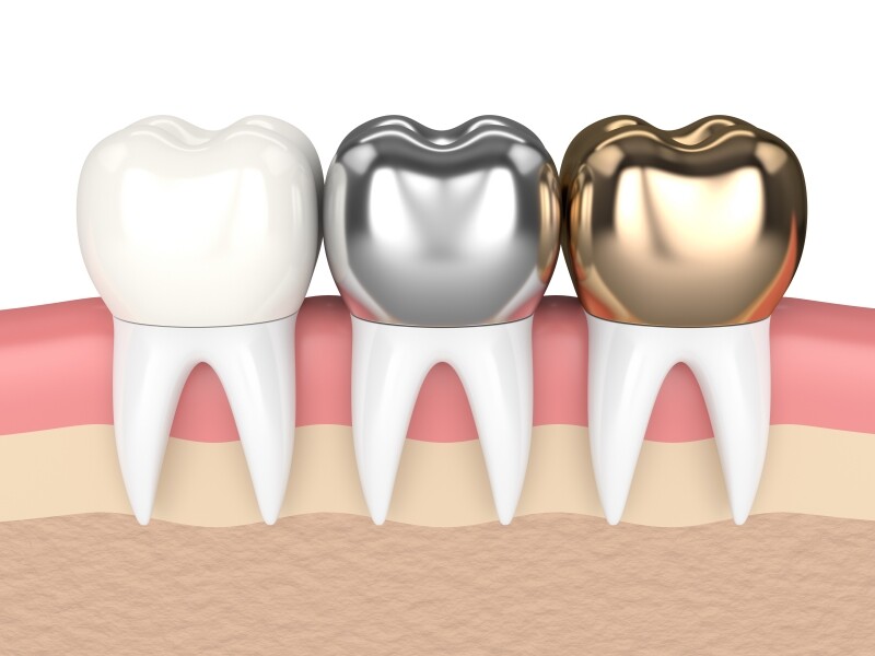 Răng sứ kim loại thường có tốt không