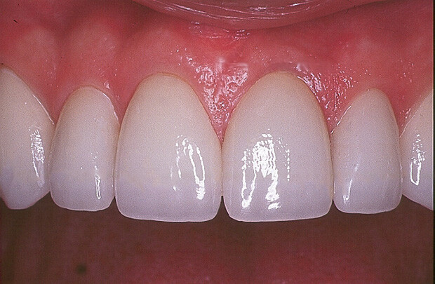 ưu điểm của răng sứ thẩm mỹ