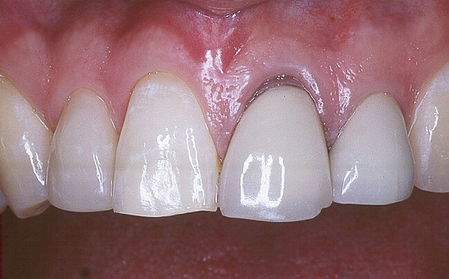 so sánh răng toàn sứ với răng sứ kim loại