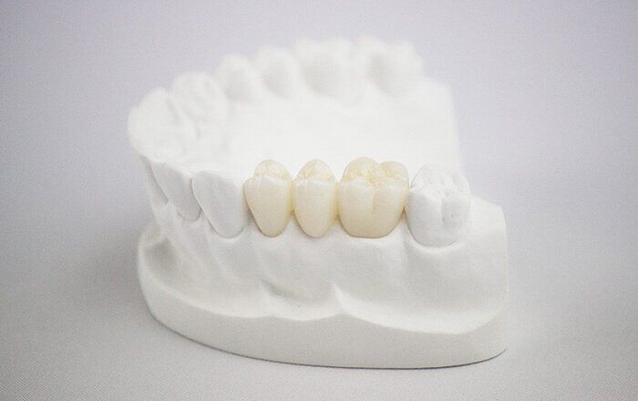 Giải pháp hiệu quả gia tăng độ bền khi bọc răng sứ Cercon HT