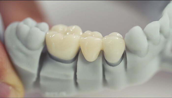 loại răng sứ phổ biến hiện nay