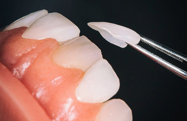 ưu điểm của răng sứ Veneer