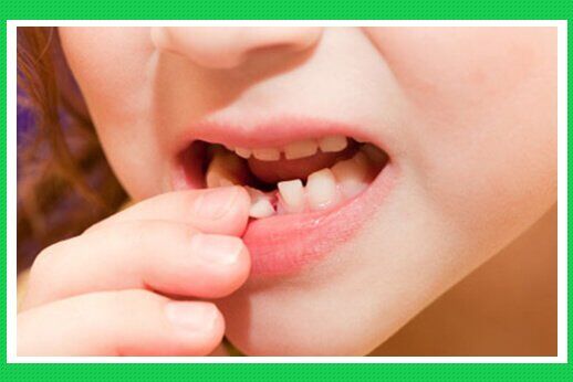 Vai trò của răng sữa với quá trình mọc răng cố định