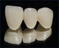 So sánh răng toàn sứ với răng sứ kim loại