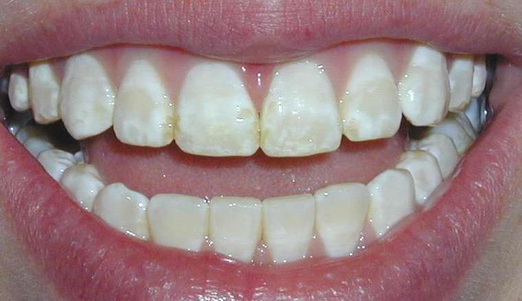 răng thiếu sản