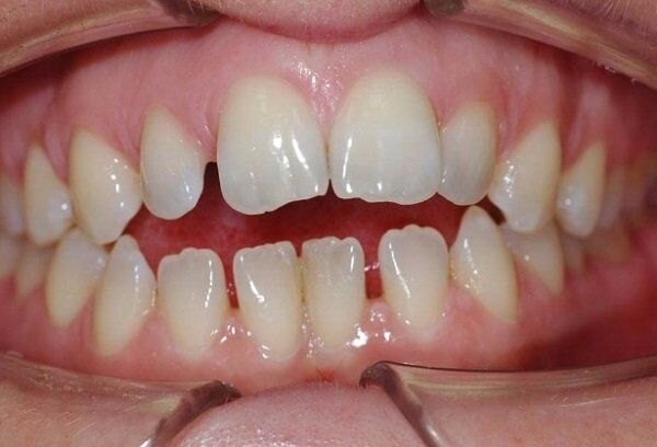 Răng thưa có bọc răng sứ Cercon được không?