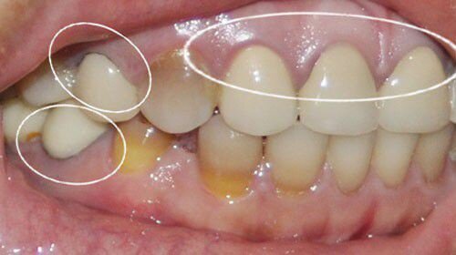 Răng thừa fluor phải làm sao ?