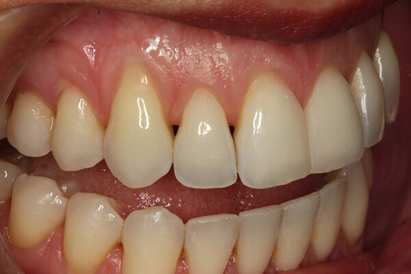 nguyên nhân gây vàng răng cơ bản
