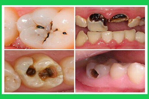 Sâu răng để lâu năm và phương pháp điều trị hiệu quả