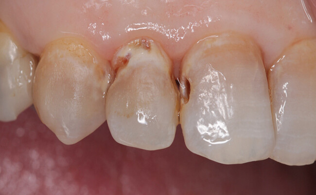 kiến thức về bệnh sâu răng