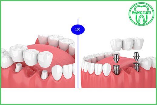 So sánh làm cầu răng và trồng răng Implant