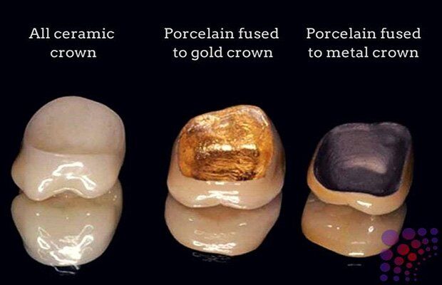 so sánh răng kim loại với răng sứ toàn sứ