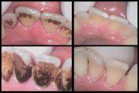 Màu sắc răng và sức khỏe răng miệng