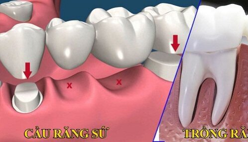 Sự khác biệt của ghép implant và làm cầu răng