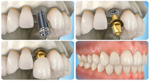 Trụ răng giả implant có bị hỏng không ?