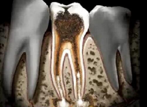 Sự khác biệt giữa viêm tủy răng hồi phục và không hồi phục