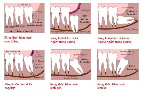Sự khác nhau giữa răng khôn và răng hàm