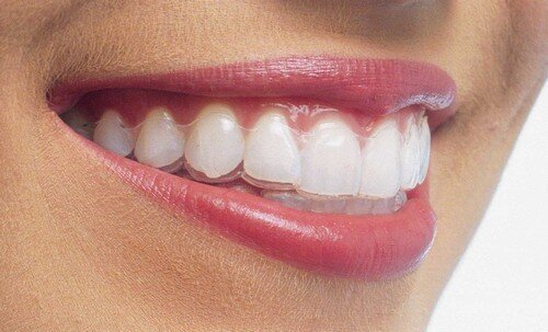 Sự phong phú của các phương pháp niềng răng