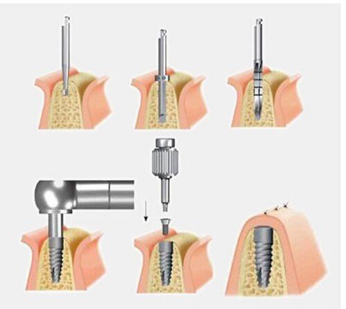 Tại sao cần nâng xoang hàm trong cắm ghép implant ?