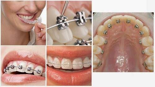 Tác dụng của niềng răng chỉnh nha 1