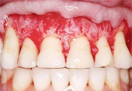 Người già và bệnh răng miệng thường gặp