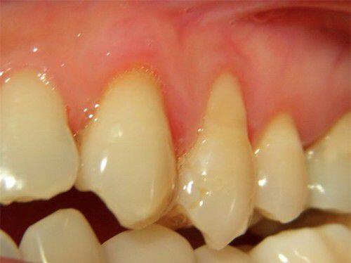 Một số triệu chứng răng miệng thường gặp