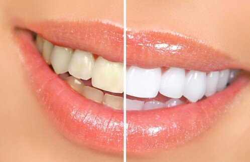 Tại sao răng nhạy cảm hơn khi tẩy trắng ?